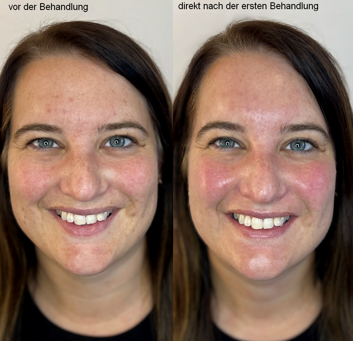 PRO FACIAL SET - Starter